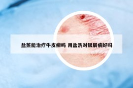 鹽蒸能治療牛皮癬嗎 用鹽洗對銀屑病好嗎
