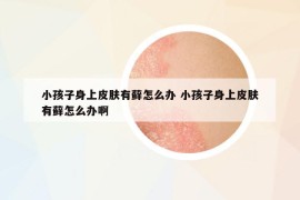 小孩子身上皮膚有蘚怎么辦 小孩子身上皮膚有蘚怎么辦啊