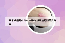 銀屑病經(jīng)期有什么注意的 銀屑病經(jīng)期前后復(fù)發(fā)