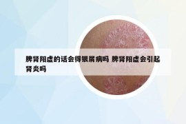 脾腎陽虛的話會(huì)得銀屑病嗎 脾腎陽虛會(huì)引起腎炎嗎
