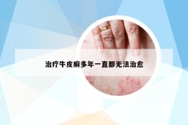 治療牛皮癬多年一直都無(wú)法治愈