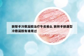 膚幫手冷敷凝膠治療牛皮癬么 膚邦手膚康型冷敷凝膠有誰用過