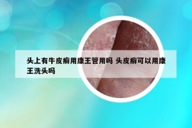 頭上有牛皮癬用康王管用嗎 頭皮癬可以用康王洗頭嗎