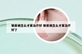 銀屑病怎么才算治療好 銀屑病怎么才算治療好了