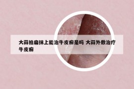 大蒜拍扁抹上能治牛皮癬是嗎 大蒜外敷治療牛皮癬