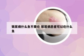 銀屑病什么魚(yú)不要吃 銀屑病患者可以吃什么魚(yú)