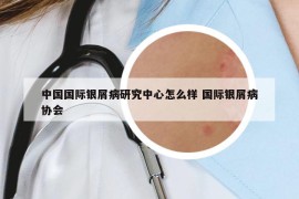 中國國際銀屑病研究中心怎么樣 國際銀屑病協(xié)會(huì)