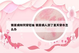 銀屑病如何穿短袖 銀屑病人到了夏天穿衣怎么辦