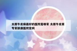太原牛皮癬最好的醫(yī)院是哪家 太原牛皮屑 專家膚康醫(yī)院官網(wǎng)