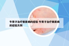 牛蒡子治療銀屑病的經(jīng)驗(yàn) 牛蒡子治療銀屑病的經(jīng)驗(yàn)方劑