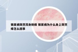 銀屑病突然渾身刺癢 銀屑病為什么身上突然癢怎么回事