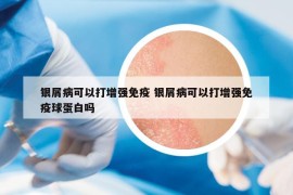 銀屑病可以打增強免疫 銀屑病可以打增強免疫球蛋白嗎
