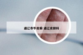 通遼市牛皮癬 通遼皮膚科