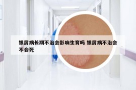 銀屑病長(zhǎng)期不治會(huì)影響生育嗎 銀屑病不治會(huì)不會(huì)死