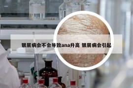 銀屑病會不會導致ana升高 銀屑病會引起
