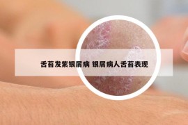舌苔發(fā)紫銀屑病 銀屑病人舌苔表現(xiàn)