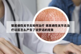 銀屑病性關(guān)節(jié)炎如何治療 銀屑病性關(guān)節(jié)炎治療以后怎么產(chǎn)生了說夢話的現(xiàn)象