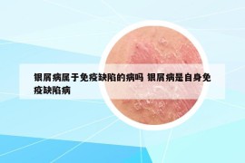 銀屑病屬于免疫缺陷的病嗎 銀屑病是自身免疫缺陷病
