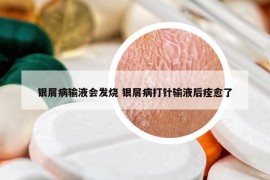 銀屑病輸液會發(fā)燒 銀屑病打針輸液后痊愈了