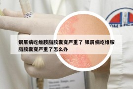 銀屑病吃維胺脂膠囊變嚴重了 銀屑病吃維胺脂膠囊變嚴重了怎么辦