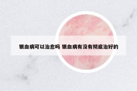 銀血病可以治愈嗎 銀血病有沒有徹底治好的