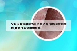 父母沒有銀屑病為什么自己有 家族沒有銀屑病,我為什么會得銀屑病