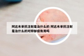 阿達木單抗注射是治什么的 阿達木單抗注射是治什么的對抑郁癥有用嗎