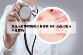 西醫(yī)治療牛皮癬的藥有哪些 有什么西藥能治牛皮廨嗎