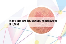 長春有銀屑病免費公益活動嗎 銀屑病長春哪里比較好