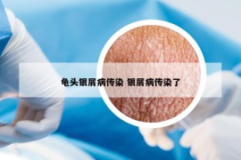 龜頭銀屑病傳染 銀屑病傳染了