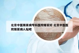 北京中醫(yī)銀屑病?？漆t(yī)院哪家好 北京中醫(yī)醫(yī)院銀屑病人貼吧