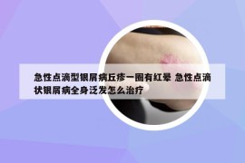 急性點(diǎn)滴型銀屑病丘疹一圈有紅暈 急性點(diǎn)滴狀銀屑病全身泛發(fā)怎么治療