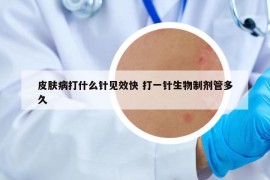 皮膚病打什么針見(jiàn)效快 打一針生物制劑管多久