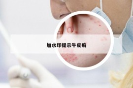 加水印提示牛皮癬