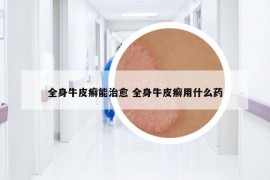 全身牛皮癬能治愈 全身牛皮癬用什么藥