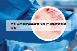 廣州治療牛皮癬要花多少錢(qián) 廣州牛皮膚癬的治療