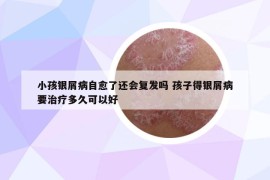 小孩銀屑病自愈了還會(huì)復(fù)發(fā)嗎 孩子得銀屑病要治療多久可以好