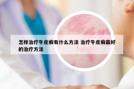 怎樣治療牛皮癬有什么方法 治療牛皮癬最好的治療方法