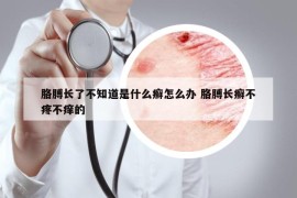 胳膊長(zhǎng)了不知道是什么癬怎么辦 胳膊長(zhǎng)癬不疼不癢的