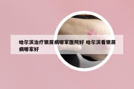 哈爾濱治療銀屑病哪家醫(yī)院好 哈爾濱看銀屑病哪家好