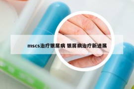 mscs治療銀屑病 銀屑病治療新進(jìn)展