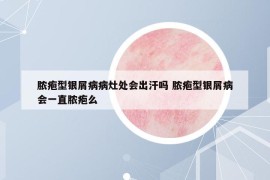 膿皰型銀屑病病灶處會出汗嗎 膿皰型銀屑病會一直膿皰么