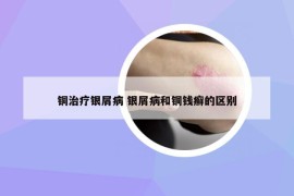 銅治療銀屑病 銀屑病和銅錢癬的區(qū)別