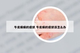牛皮癬癬的癥狀 牛皮癬的癥狀該怎么辦