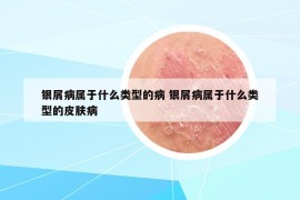 銀屑病屬于什么類型的病 銀屑病屬于什么類型的皮膚病