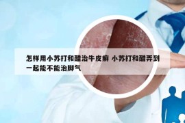 怎樣用小蘇打和醋治牛皮癬 小蘇打和醋弄到一起能不能治腳氣