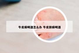 牛皮癬喝酒怎么辦 牛皮膚癬喝酒