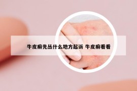 牛皮癬先叢什么地方起訴 牛皮癬看看