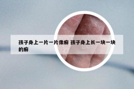 孩子身上一片一片像癬 孩子身上長(zhǎng)一塊一塊的癬