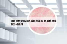 銀屑病照完uvb之后斑點(diǎn)發(fā)紅 銀屑病照完紫外線很癢